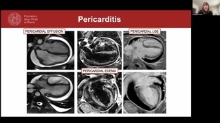 Pericarditis, constriction physiology and clinical conclusions
