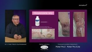 Przewlekłe zapalenie, biofilm i obciążenie mikrobiologiczne