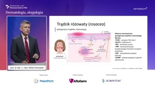 Trądzik różowaty: obraz kliniczny, przyczyny i leczenie