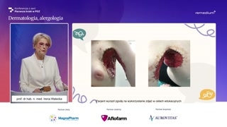 Obraz kliniczny u dzieci i młodzieży oraz powikłania