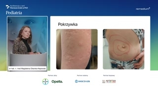 Obraz kliniczny wysypek: pokrzywka, rumień trwały i fototoksyczność